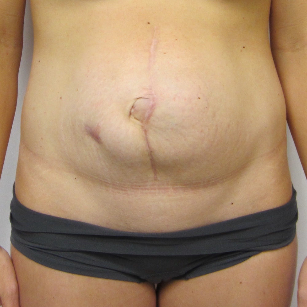procedure-hernia-surgery hernia surgery atlanta