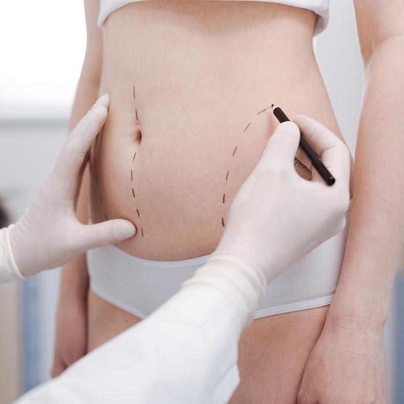 procedure-liposuction-01 liposuction atlanta